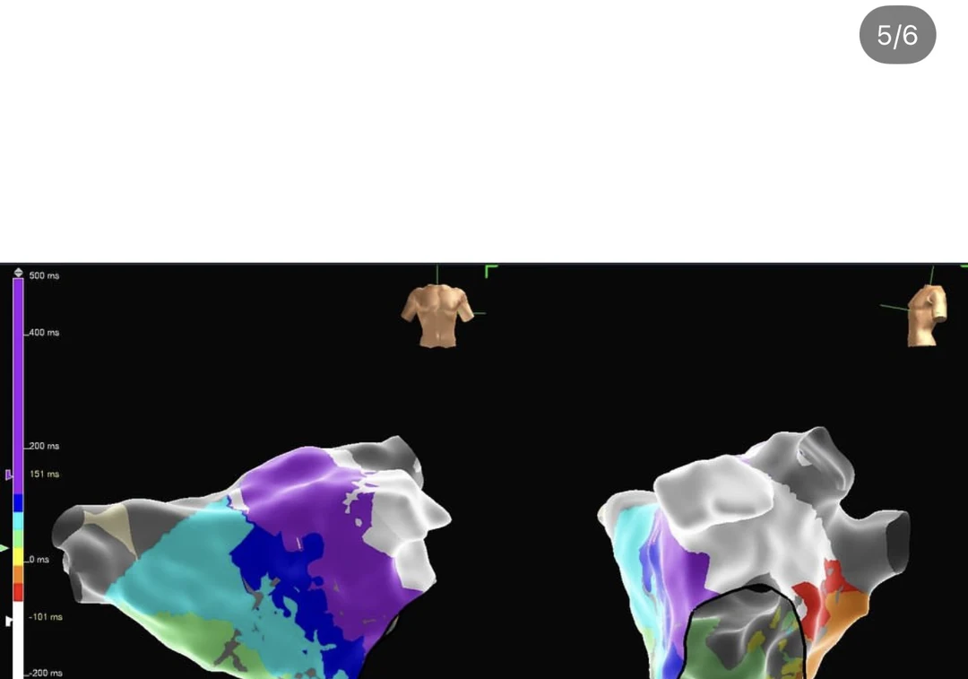Mapa eletroanatômico tridimensional do átrio esquerdo